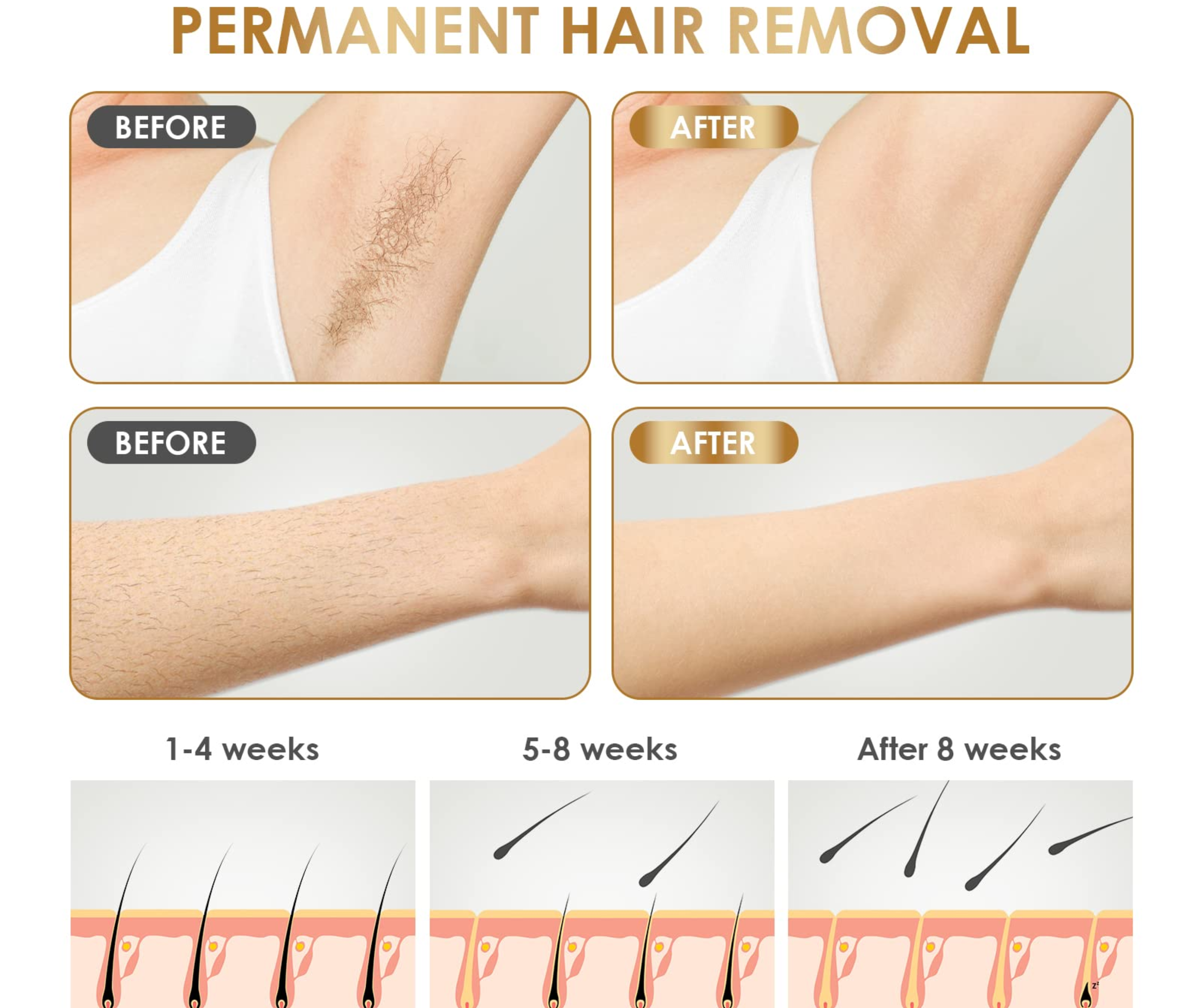 LUX SKINS® - #1 in Permanent Hair Removal