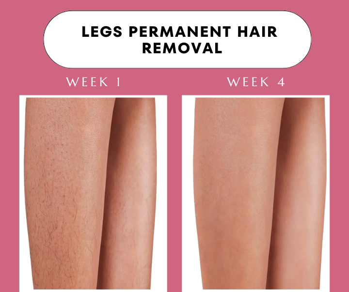 Advanced IPL Hair Laser Removal Device + Ultra Fast