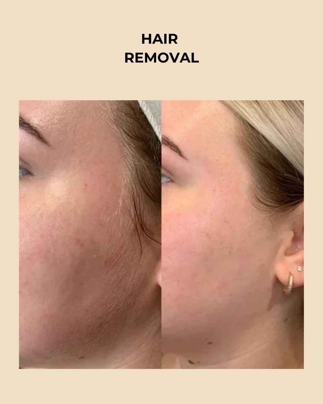 Premium  3-in-1 Wireless Laser Hair & Skin Device