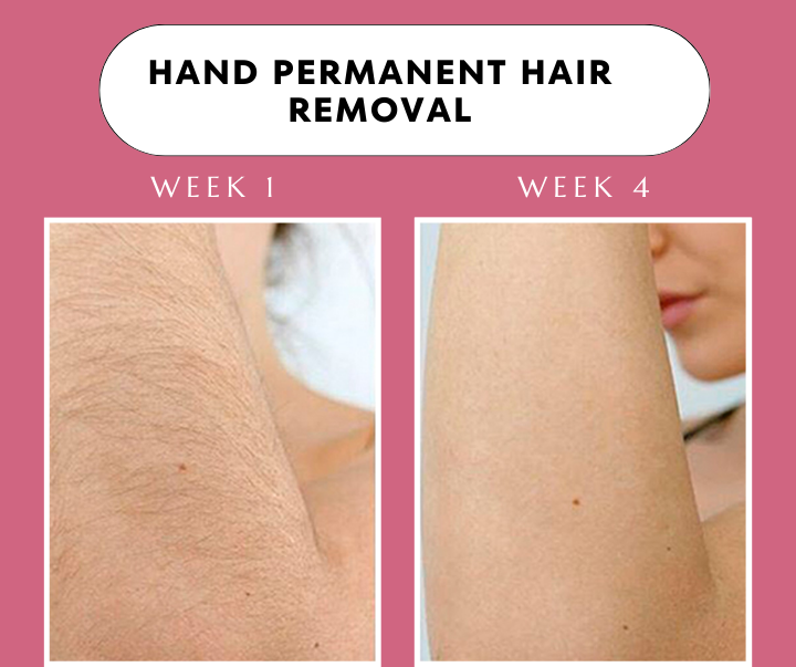 Advanced IPL Hair Laser Removal Device + Ultra Fast