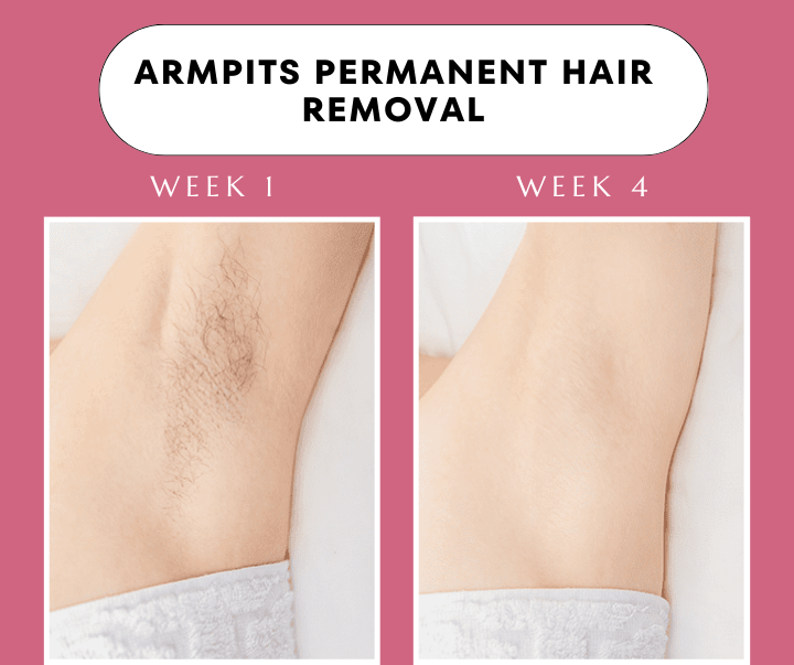 Advanced IPL Hair Laser Removal Device + Ultra Fast