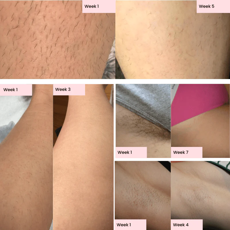 Advanced IPL Hair Laser Removal Device + Ultra Fast