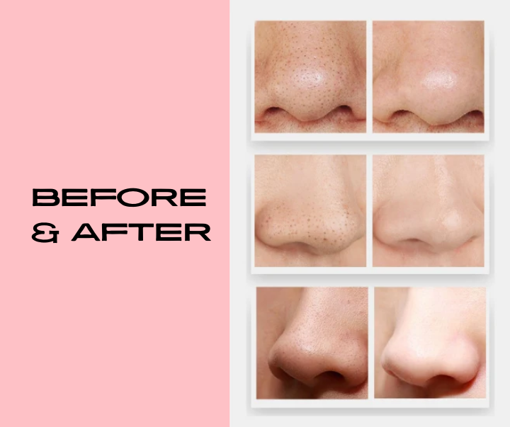 Before and after results using Lux Skins® vacuum pore cleaner – blackhead removal and pore tightening visible on nose area